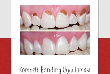 Estetik Dolgu – Bonding Tekniği