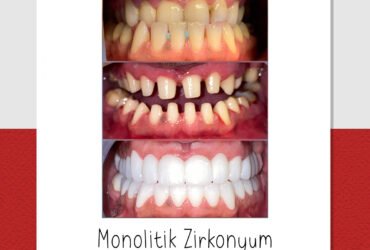 Diş İmplant